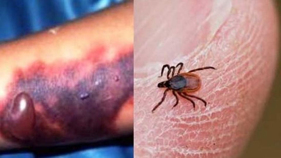 راه‌های پیشگیری از بیماری تب کریمه کنگو (CCHF)